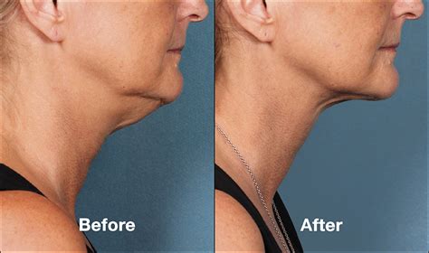 Kybella Injection: Here's How To Get Rid Of That Double Chin.